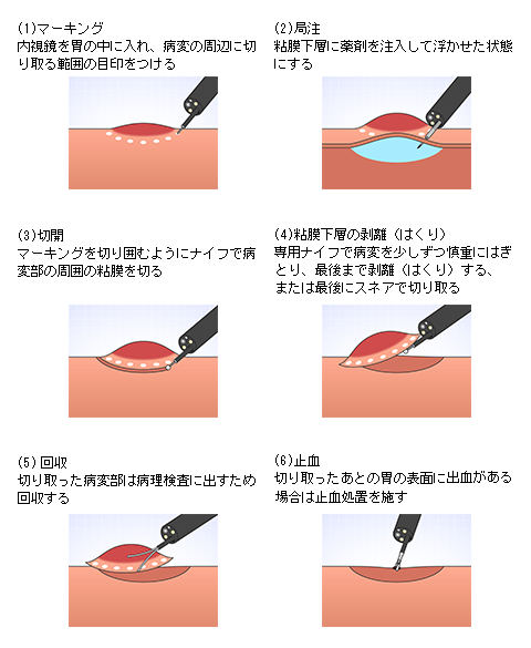 ESDの手技