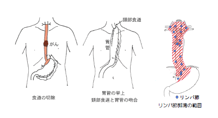 食道がんの治療法