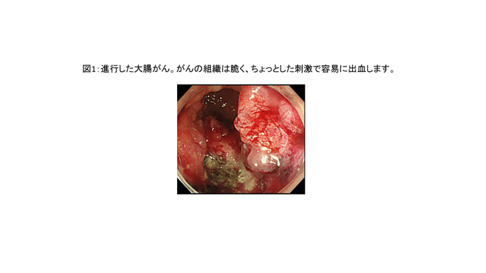 図1:進行した大腸がん。がんの組織は脆く、ちょっとした刺激で容易に出血します。
