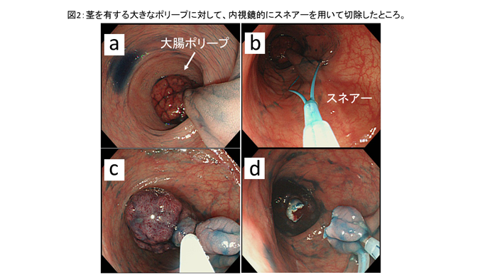 図2:茎を有する大きなポリーブに対して、内視鏡的にスネアーを用いて切除したところ。