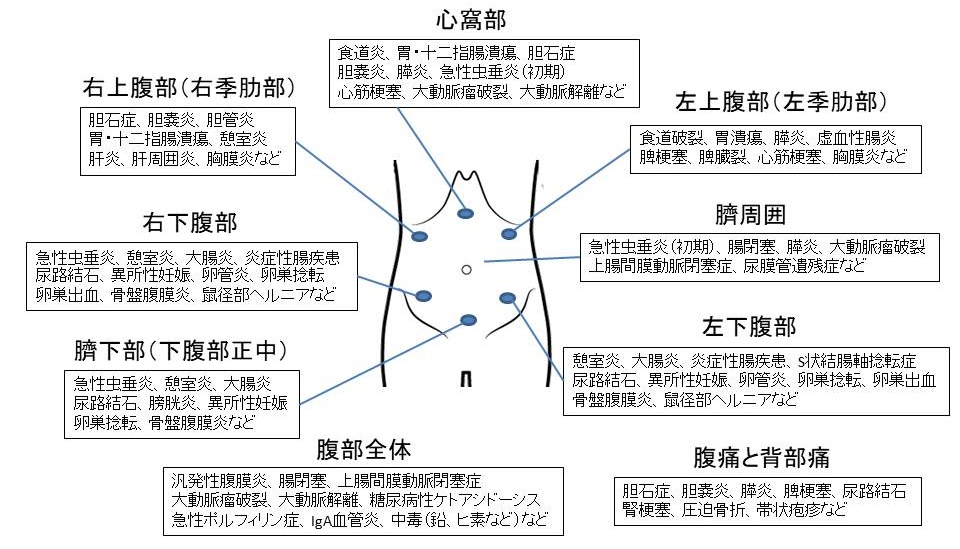 腹痛の部位と主な病気