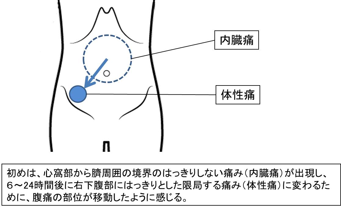 急性虫垂炎の典型的な腹痛