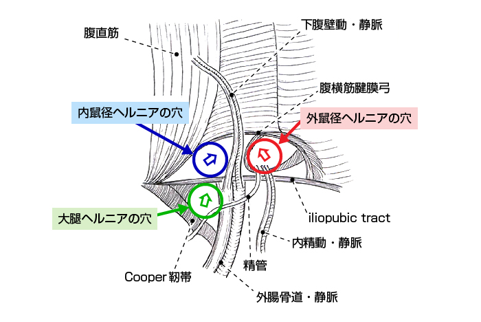 腹腔側より眺めた3種類のヘルニアの穴