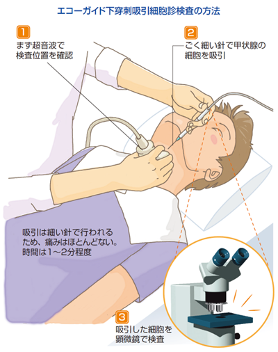 穿刺吸引細胞診検査