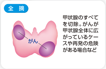 甲状腺切除範囲 全摘