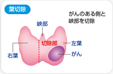 甲状腺切除範囲 葉切除