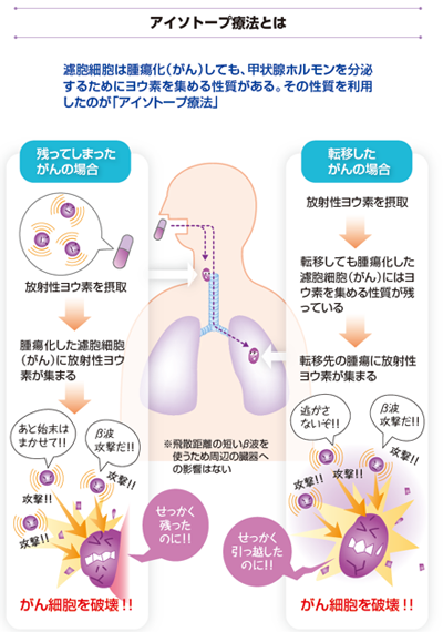 アイソトープ治療