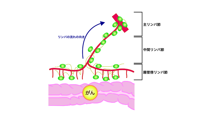 リンパ節転移