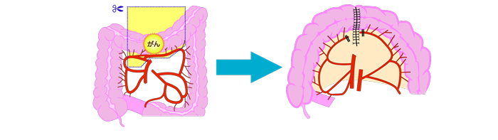 横行結腸切除術