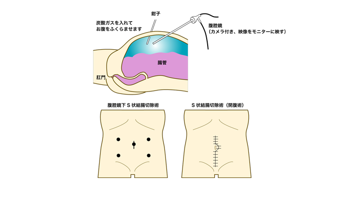 腹腔鏡手術