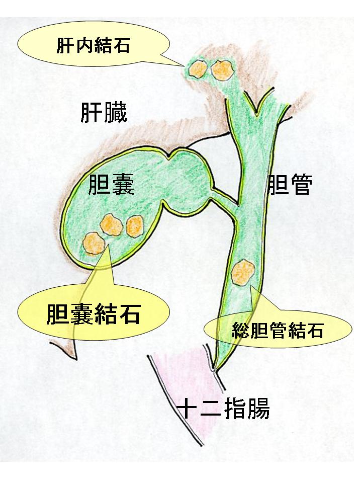 胆石のできる場所