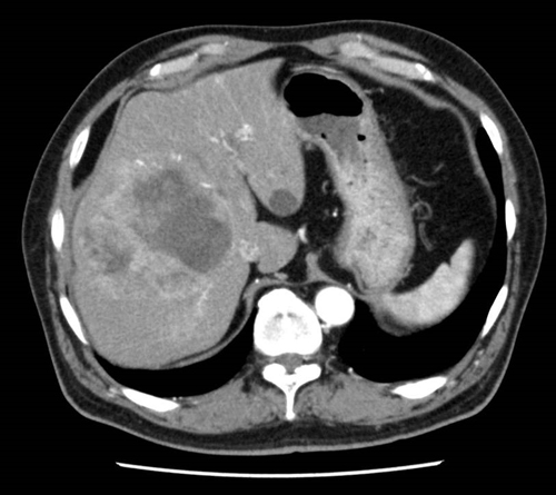 図4　肝細胞癌のCT画像の一例