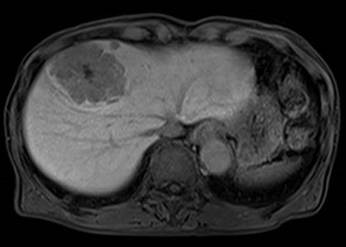 図5　転移性肝癌のMRI画像の一例