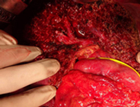 図9　系統的肝切除を行った切除後の肝臓