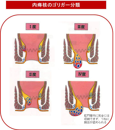 内痔核Ⅰ度・Ⅱ度・Ⅲ度・Ⅳ度