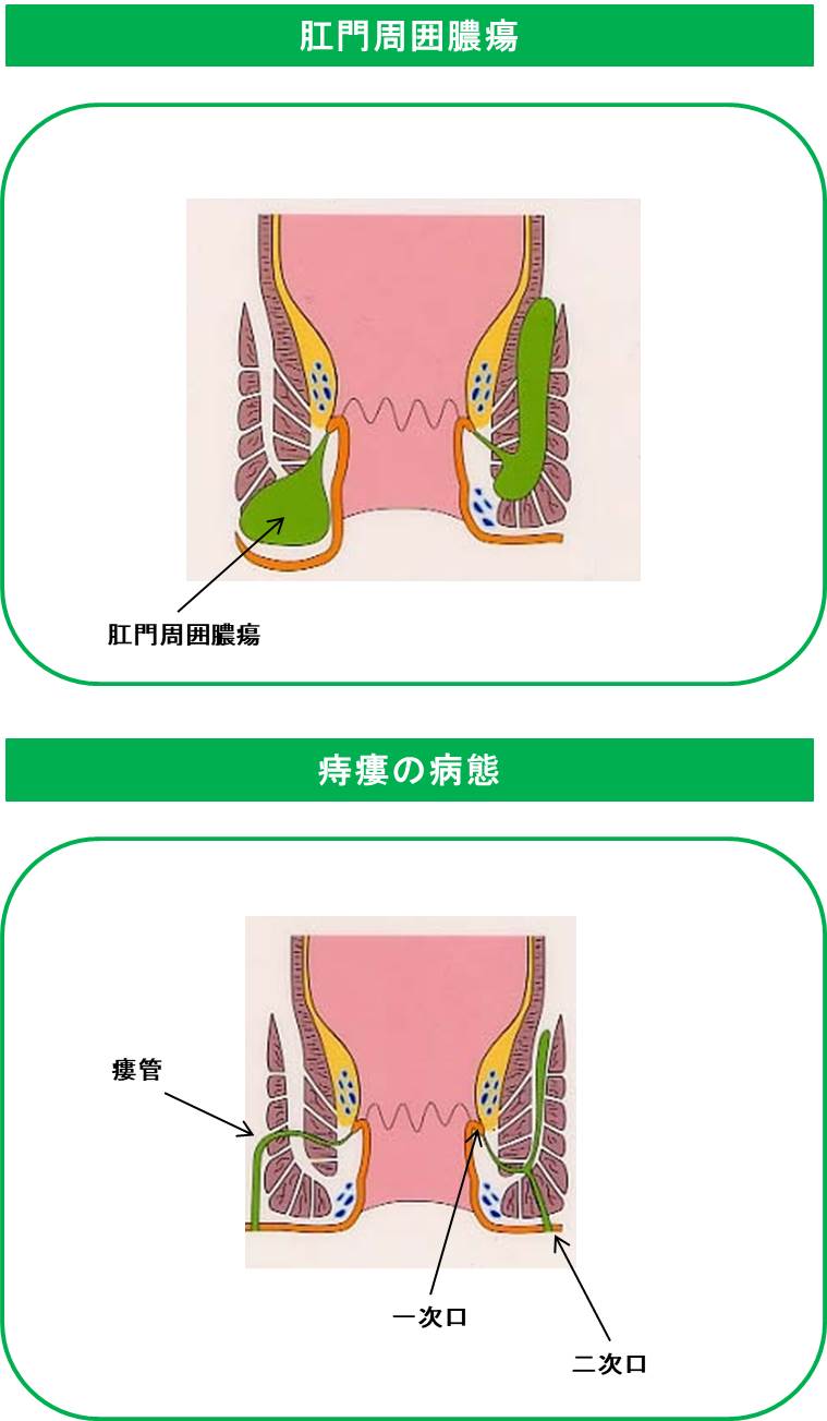 肛門周囲膿瘍から痔瘻、痔瘻浅い、深い