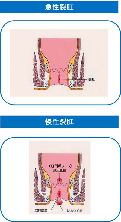 裂肛の図