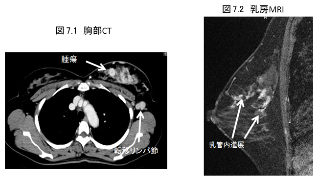 養子T細胞療法とは何ですか?