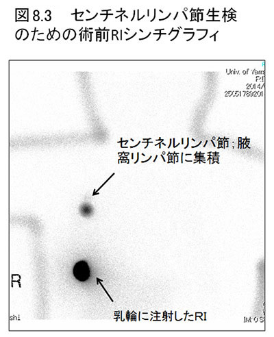 図8.3センチネルリンパ節生検のための術前RIシンチグラフィ